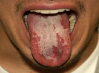Ağız İçi Dil Yaraları Belirtileri ve Tedavisi