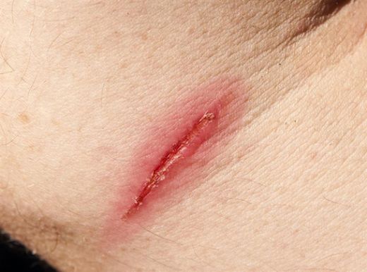 Yara Dondurma Yöntemleri