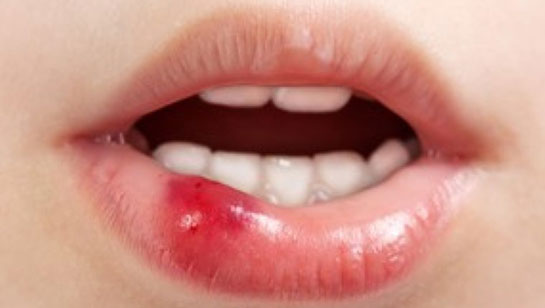 Ağız Yaraları Belirtileri ve Tedavisi