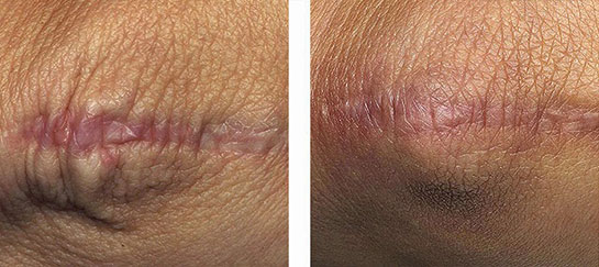 Ameliyat Yara İzi Nasıl Geçer?