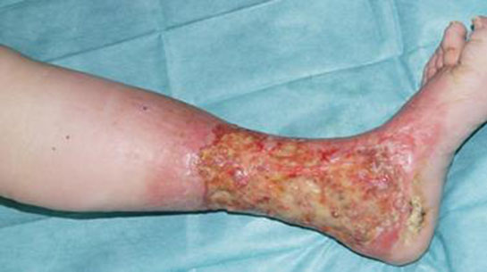 Bacaktaki Yara İzleri Nasıl Geçer?