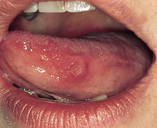 Dilde Çıkan Yaralar Nelerdir?