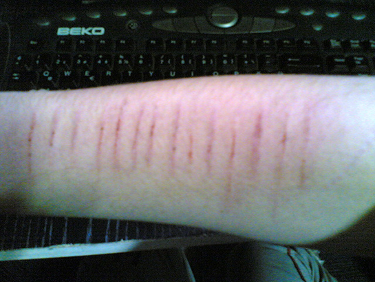 Jilet Yarası Belirtileri ve Tedavisi