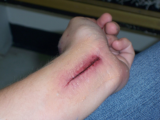 Kesik Yaralar Belirtileri ve Tedavisi