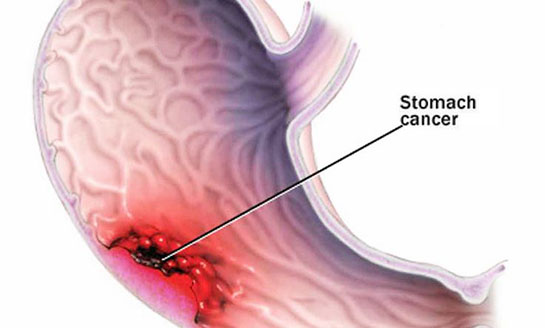Mide Yarası Belirtileri ve Tedavisi