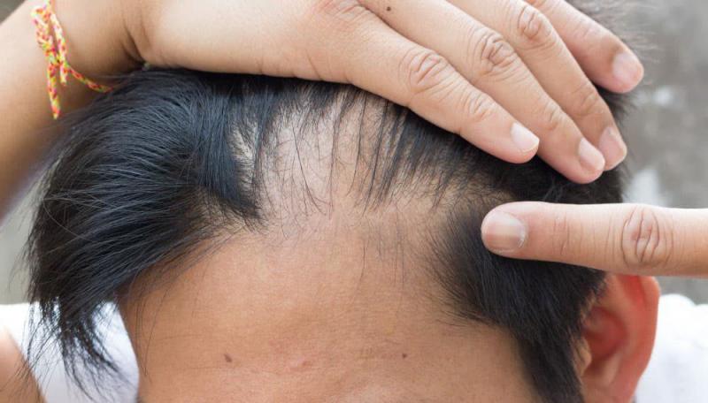 Saç Derisinde Yara Belirtileri ve Tedavisi