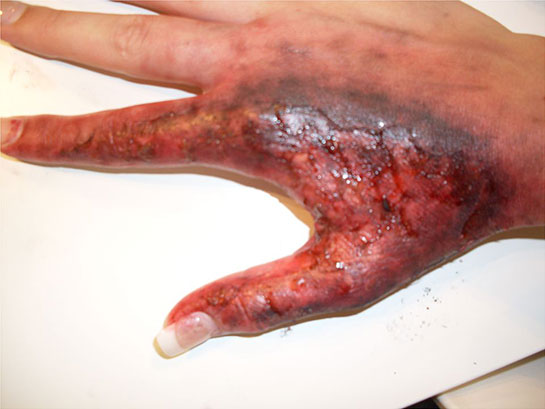 Yanık Yarası Belirtileri ve Tedavisi