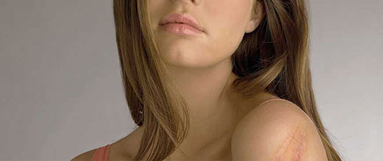 Yara Estetiği Nasıl Yapılır?